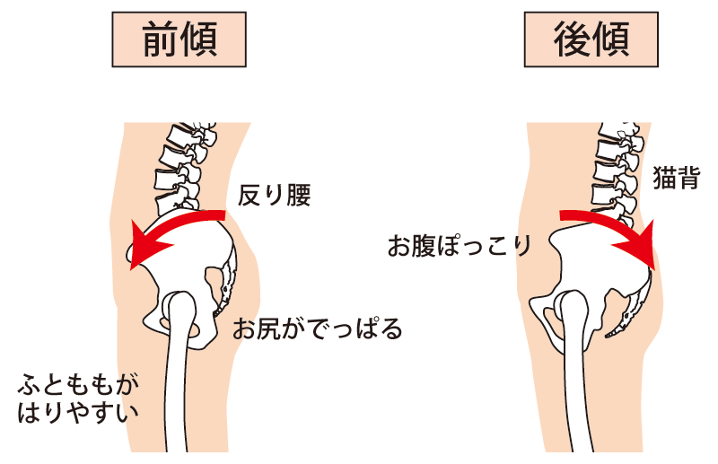 骨盤の歪み 図解
